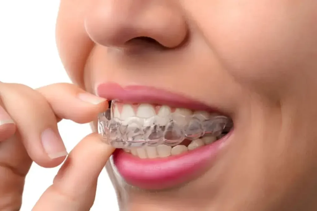 Invisalign Process