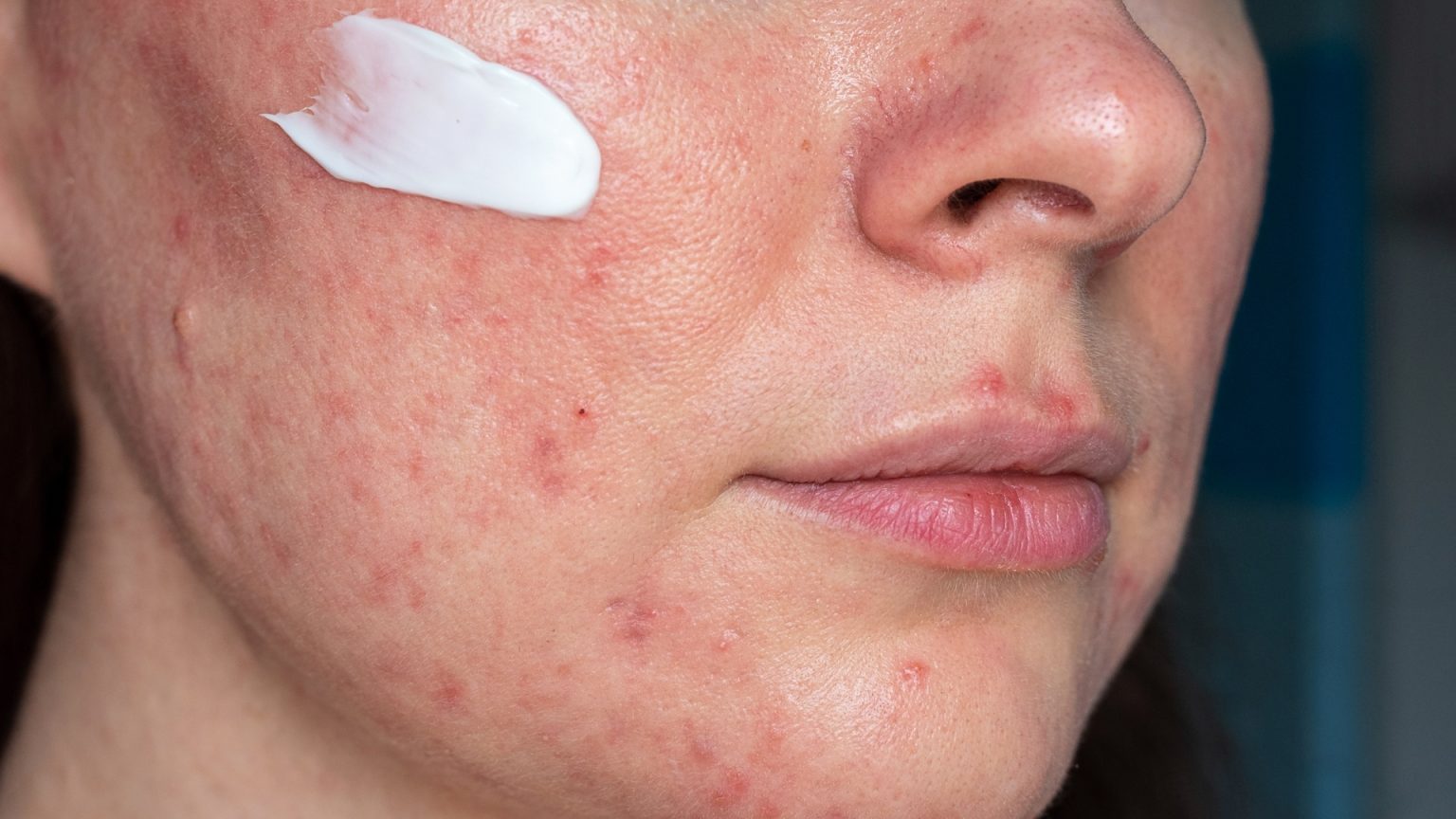 Managing Rosacea Warts