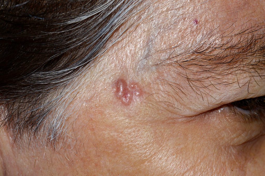 Basal Cell Carcinoma