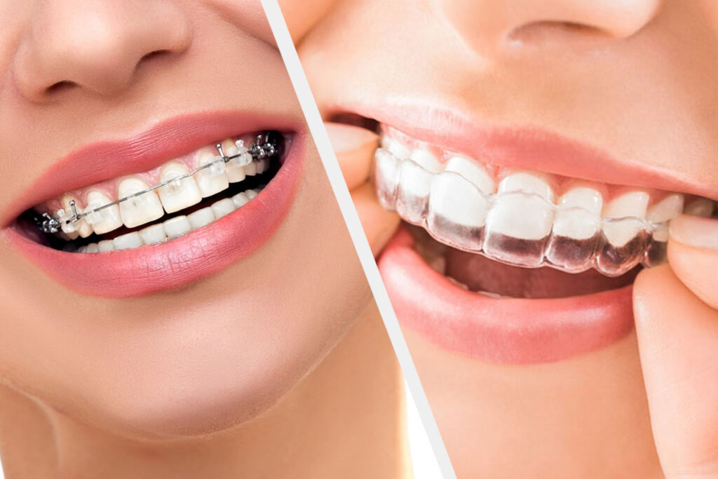 Invisalign vs. Braces and Which Orthodontic Solution Is Right for You? Invisalign vs. Braces