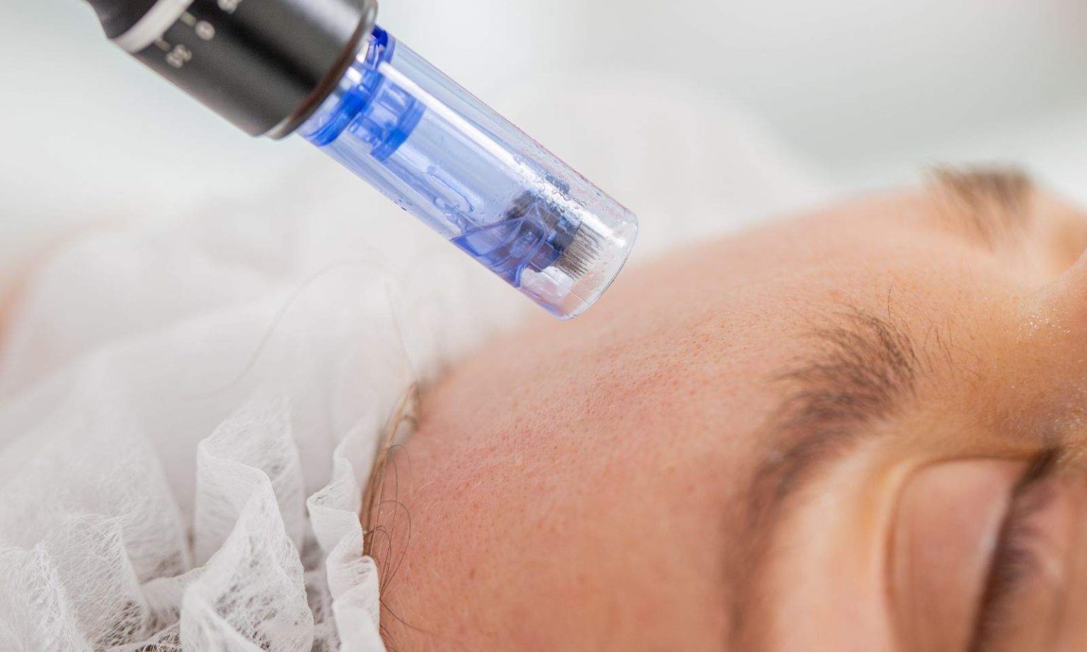 Benefits of Microneedling