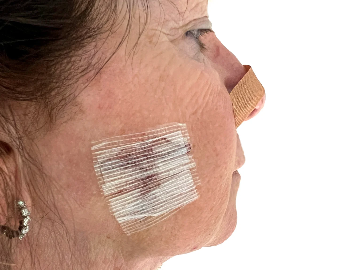 Exploring the Mohs Surgery Techniques