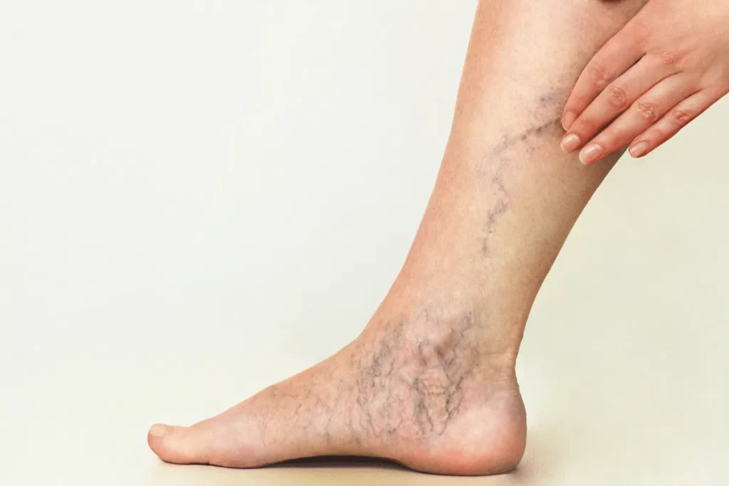 How To Prevent and Treat Varicose Veins Prevent and Treat Varicose Veins