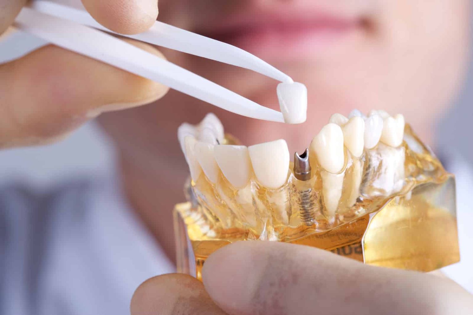 Exploring Your Options for Dental Implants Dental Implants